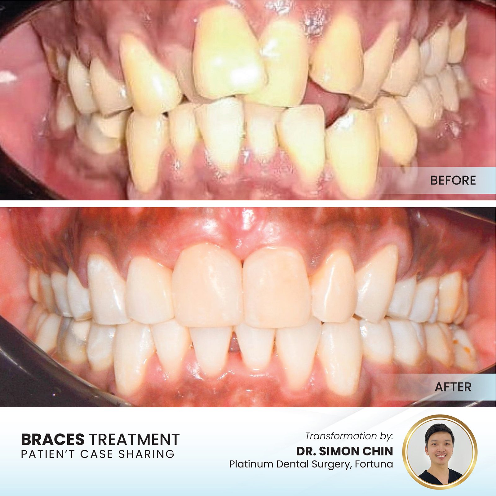 Patient smile transformation - Case I-11