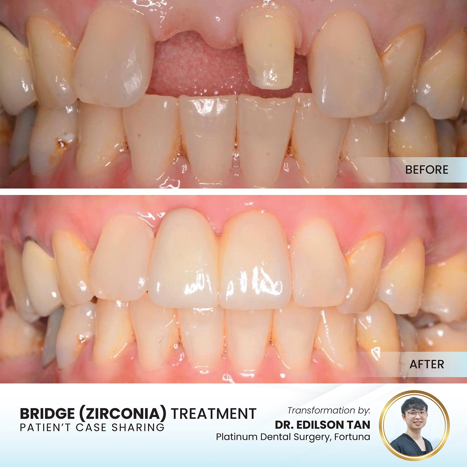 Patient smile transformation - Case I-8