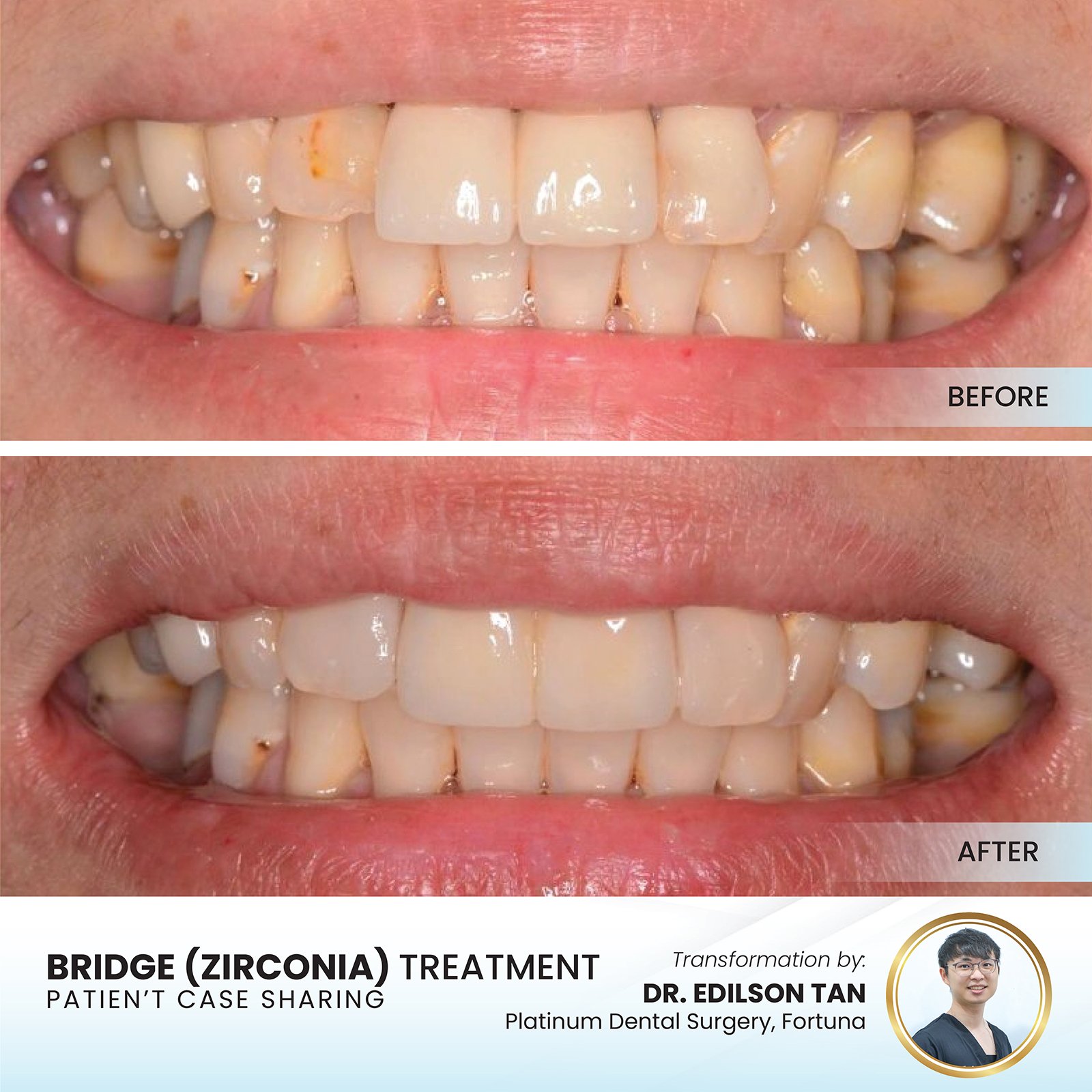 Patient smile transformation - Case I-9