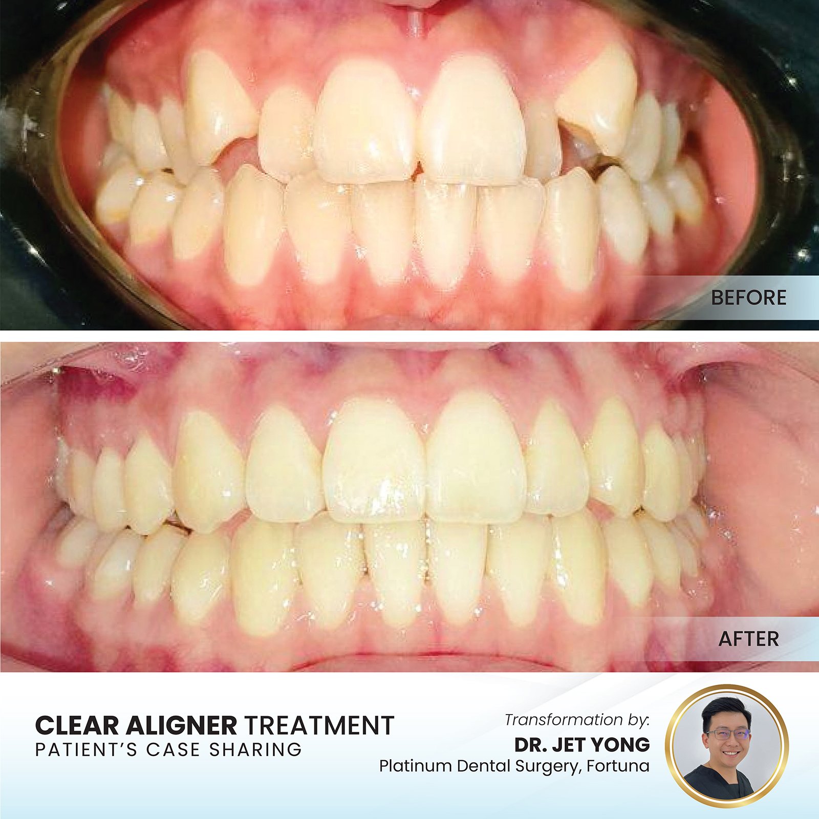 Patient smile transformation - Case II-15