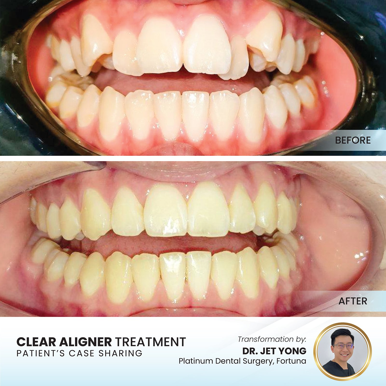 Patient smile transformation - Case II-16