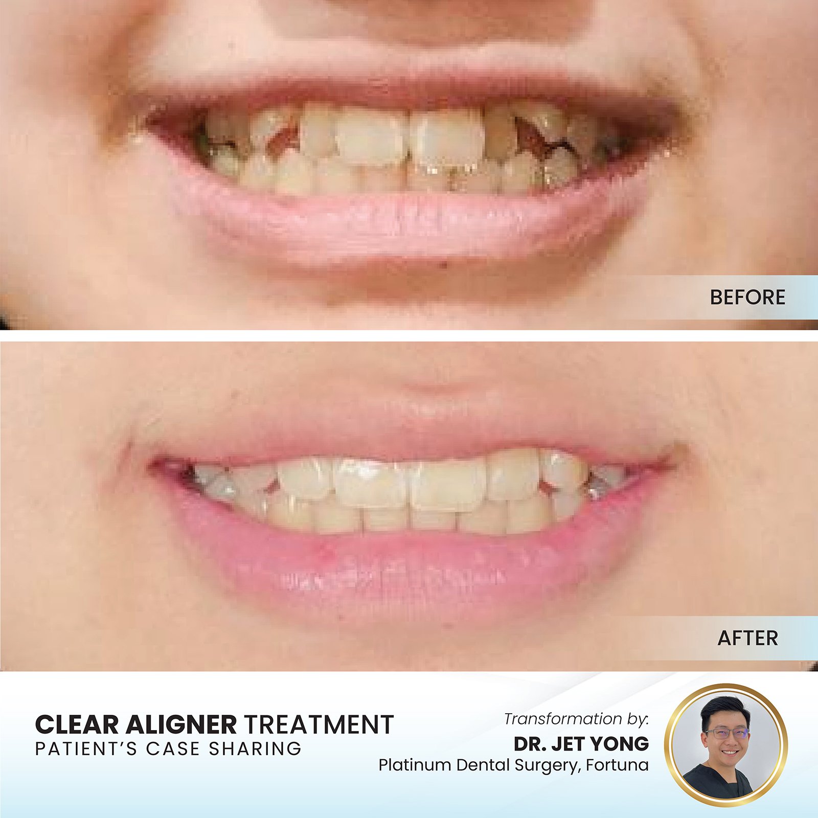 Patient smile transformation - Case II-17