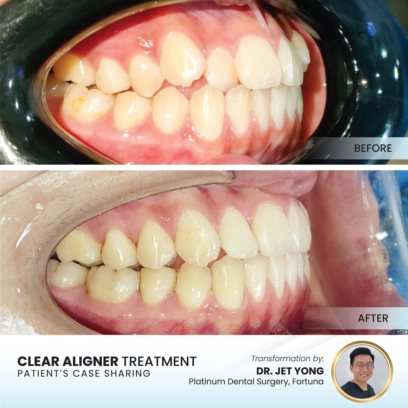 Patient smile transformation - Case II-18