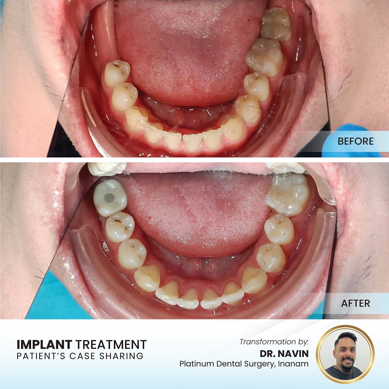 Patient smile transformation - Case II-21