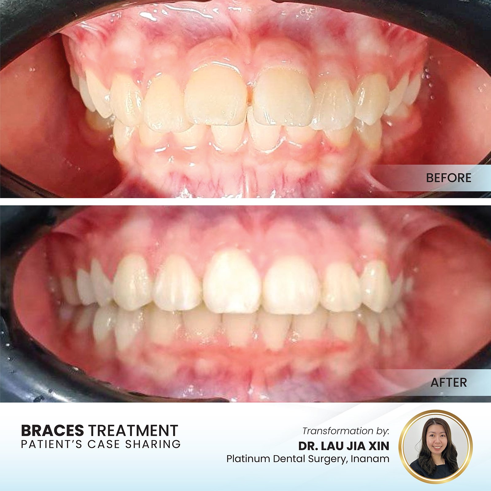 Patient smile transformation - Case II-24