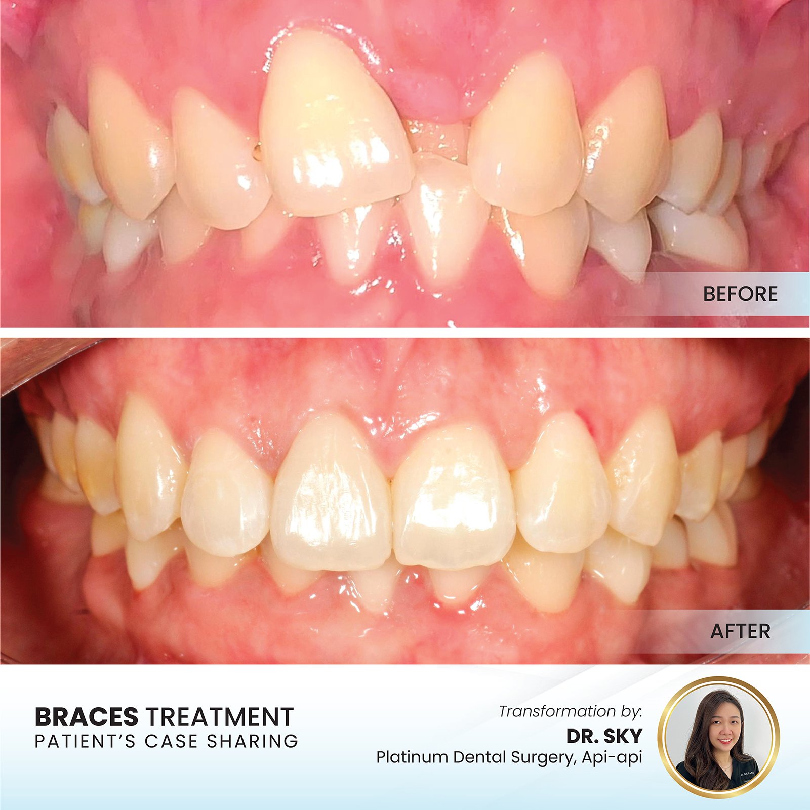 Patient smile transformation - Case II-4