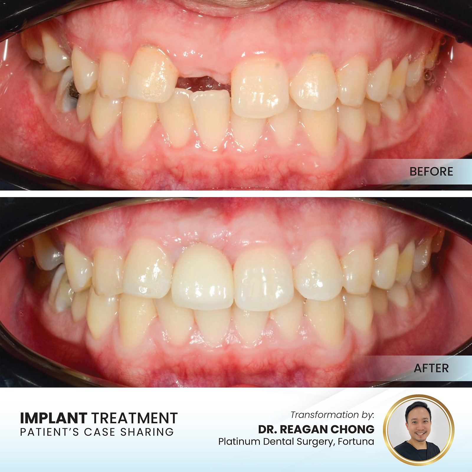 Patient smile transformation - Case II-9