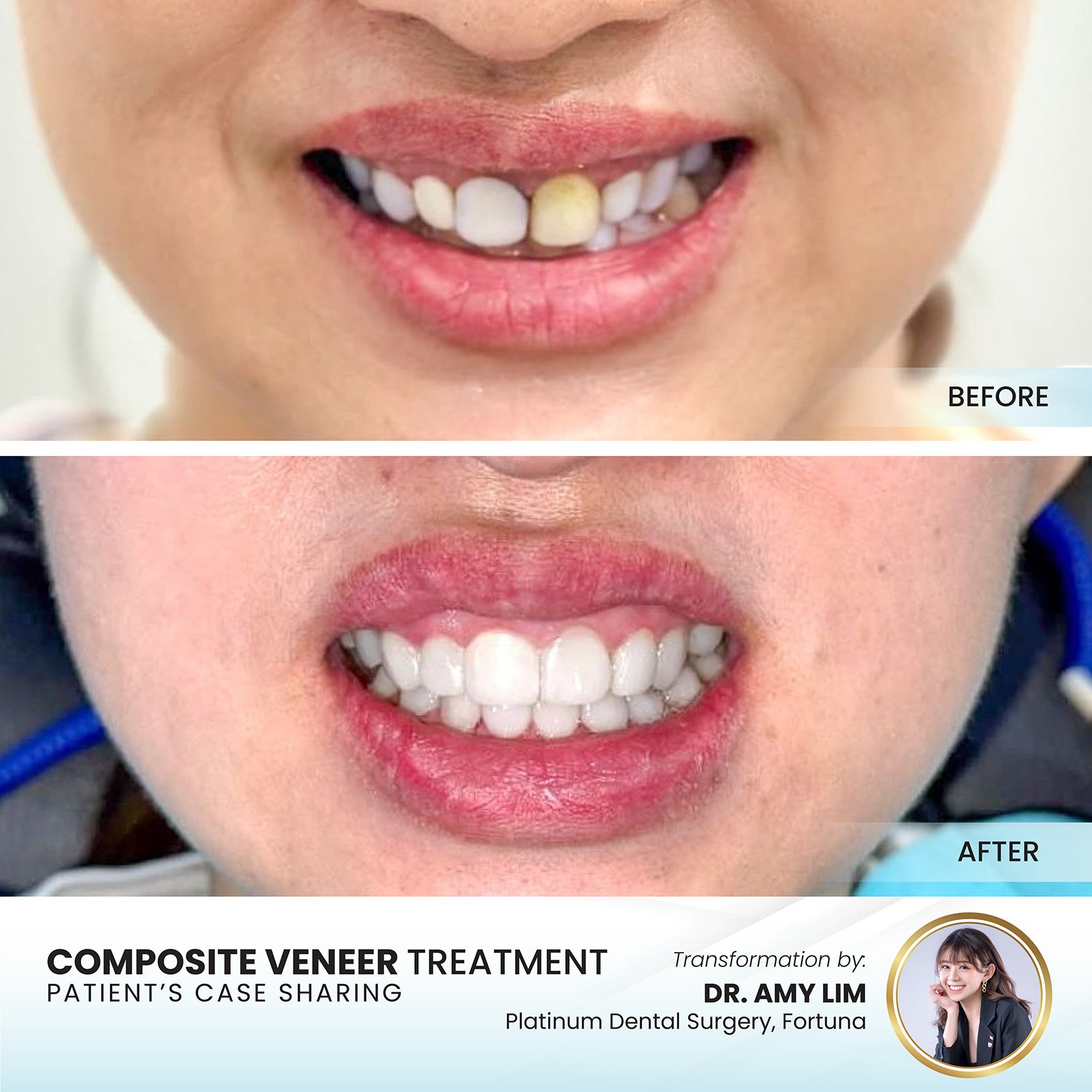 SEBARIS clear aligner result Kota Kinabalu