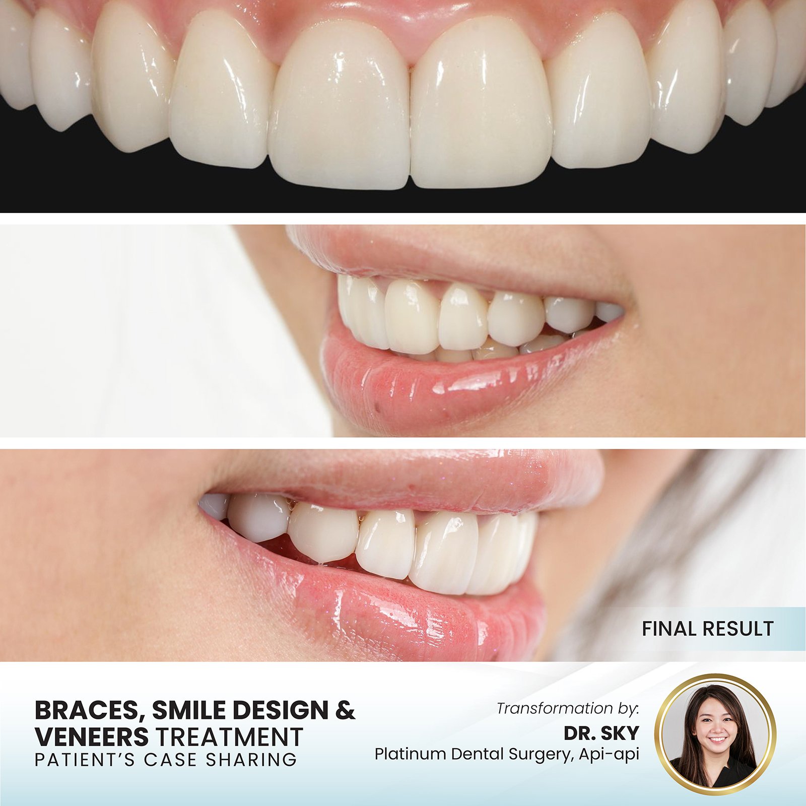 Clear aligner teeth straightening PDG KK