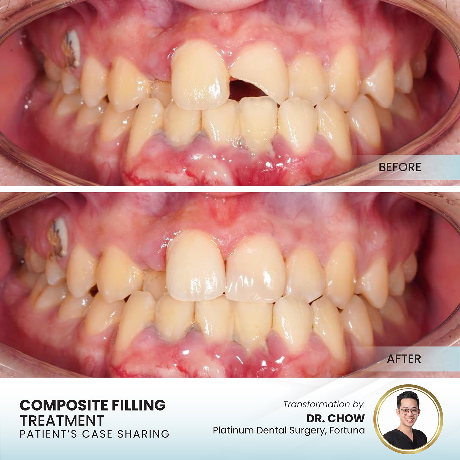 SEBARIS aligner before after results PDG