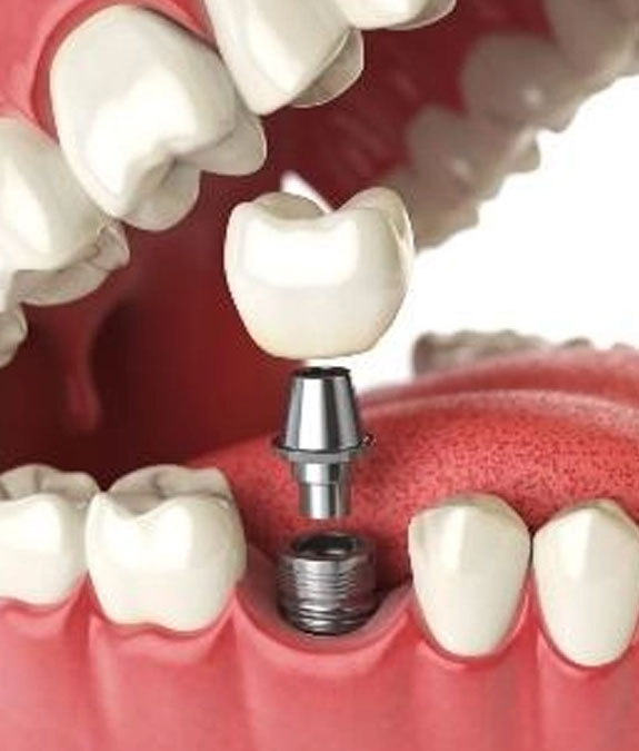 Comfortable dental implant result Platinum Dental KK