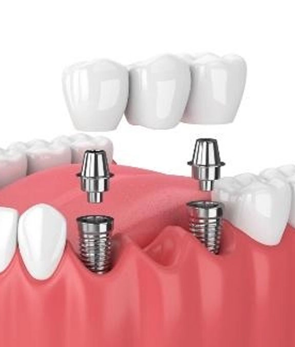 Pain-free implant experience Platinum Dental