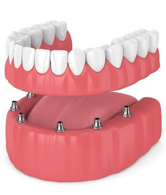 Guided implant surgery comfort experience KK
