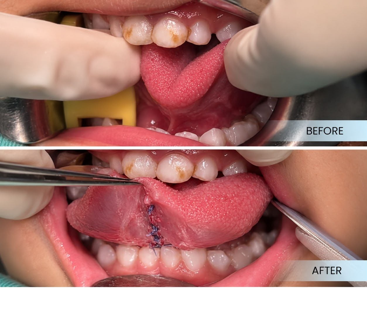 Tongue tie release surgery (lingual frenectomy) case sharing at Platinum Dental Group