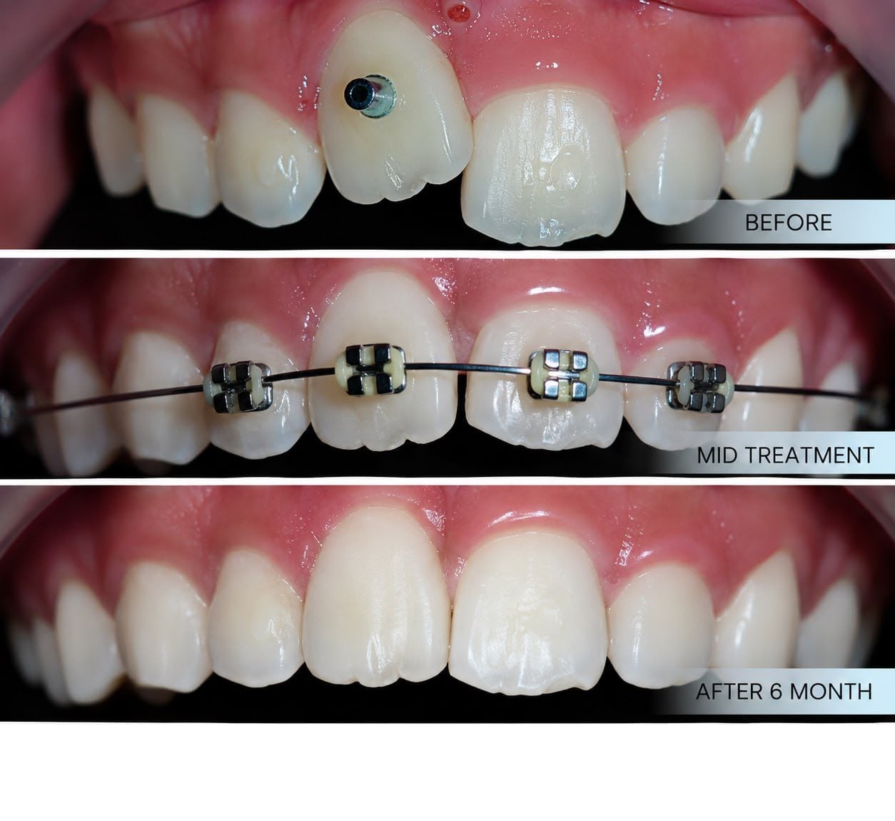 Early orthodontic treatment case sharing at Platinum Dental Group