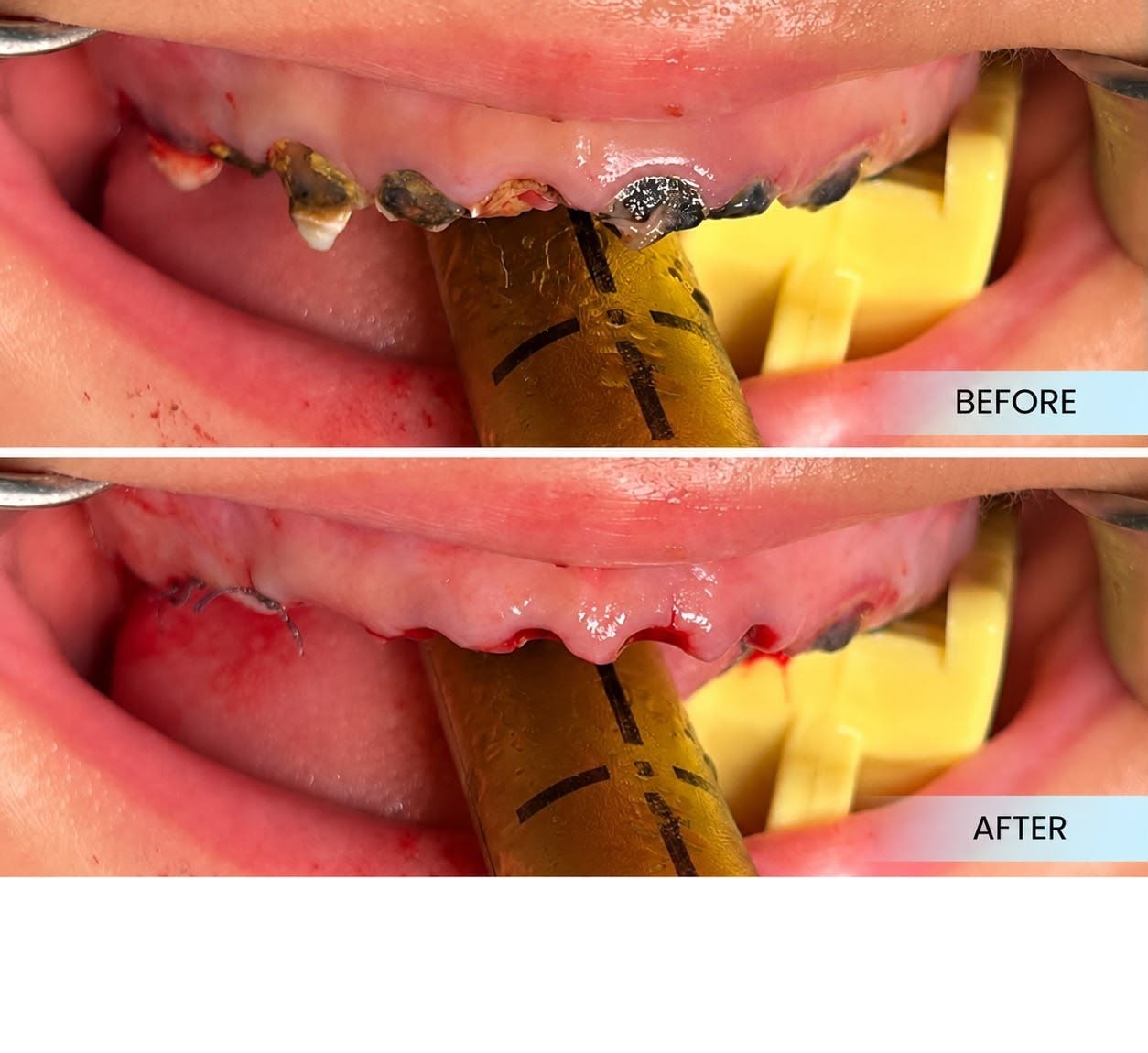 Dental extraction for carious teeth under general anaesthesia case sharing