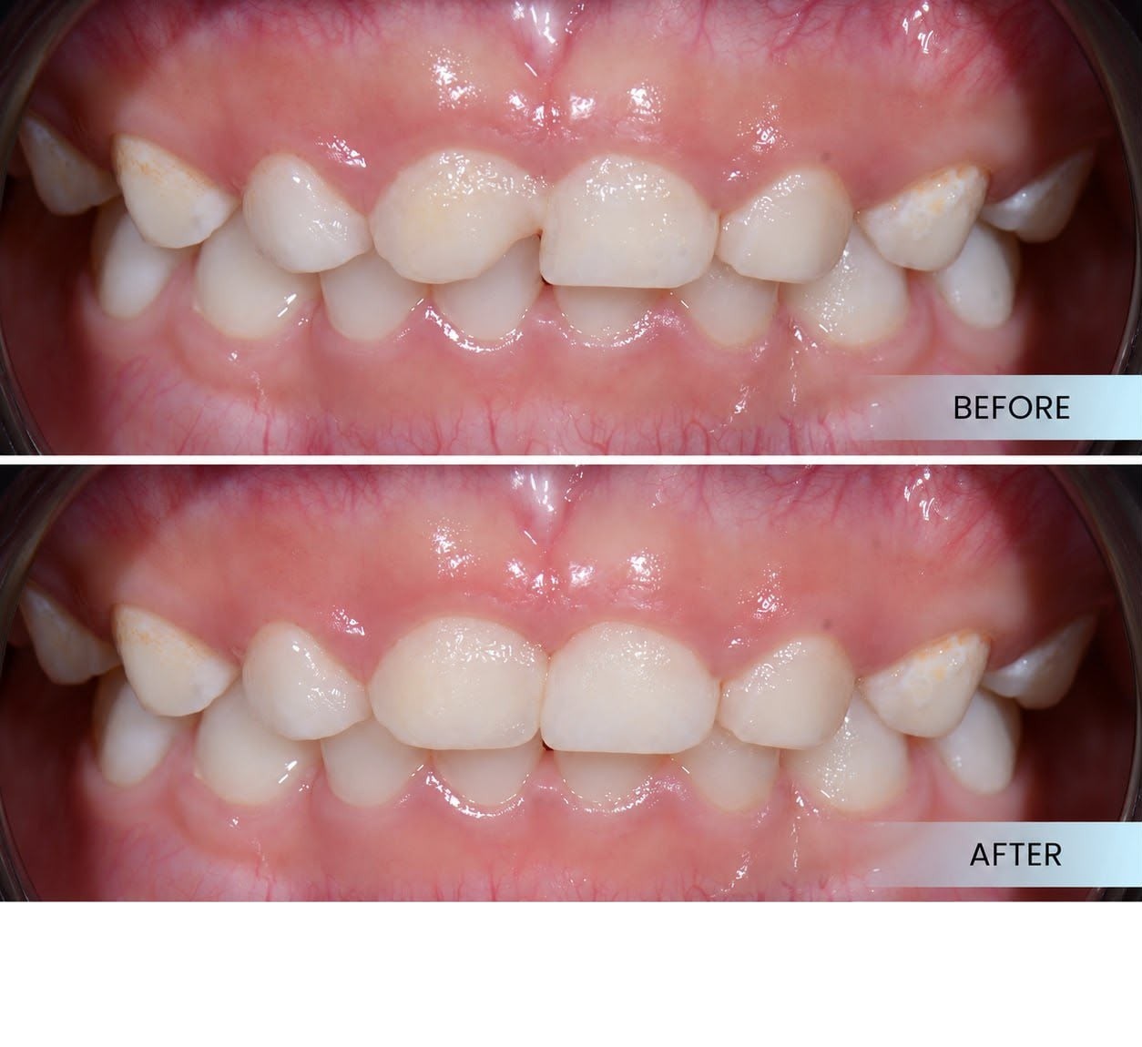 Filling treatment case sharing at Platinum Dental Group