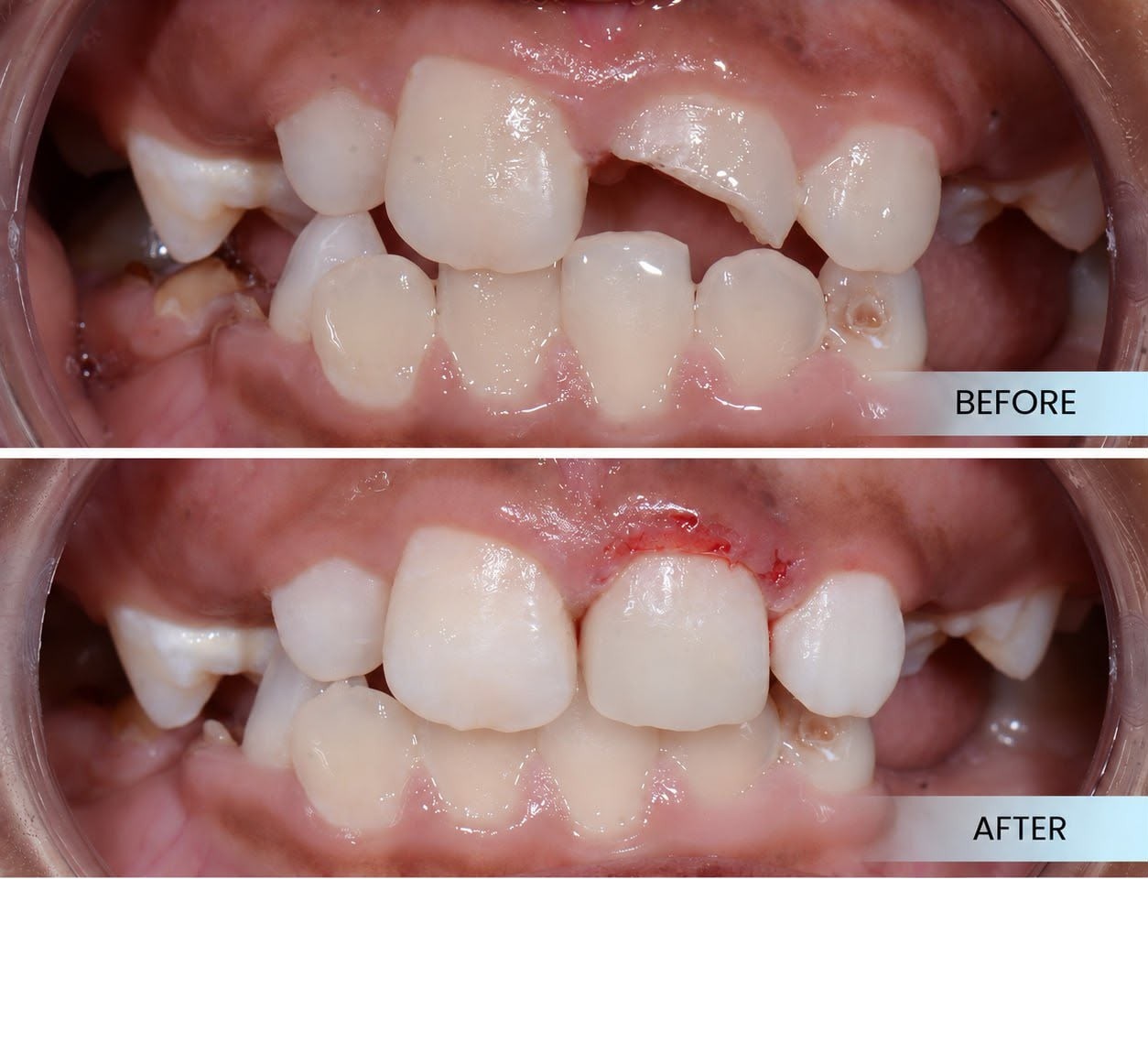 Dental trauma repair case sharing at Platinum Dental Group