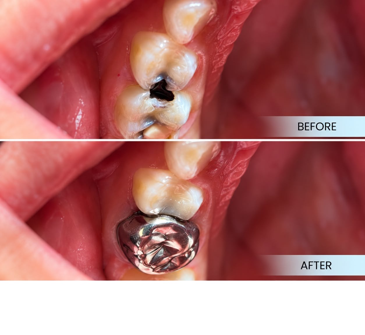 Stainless steel crown case sharing at Platinum Dental Group