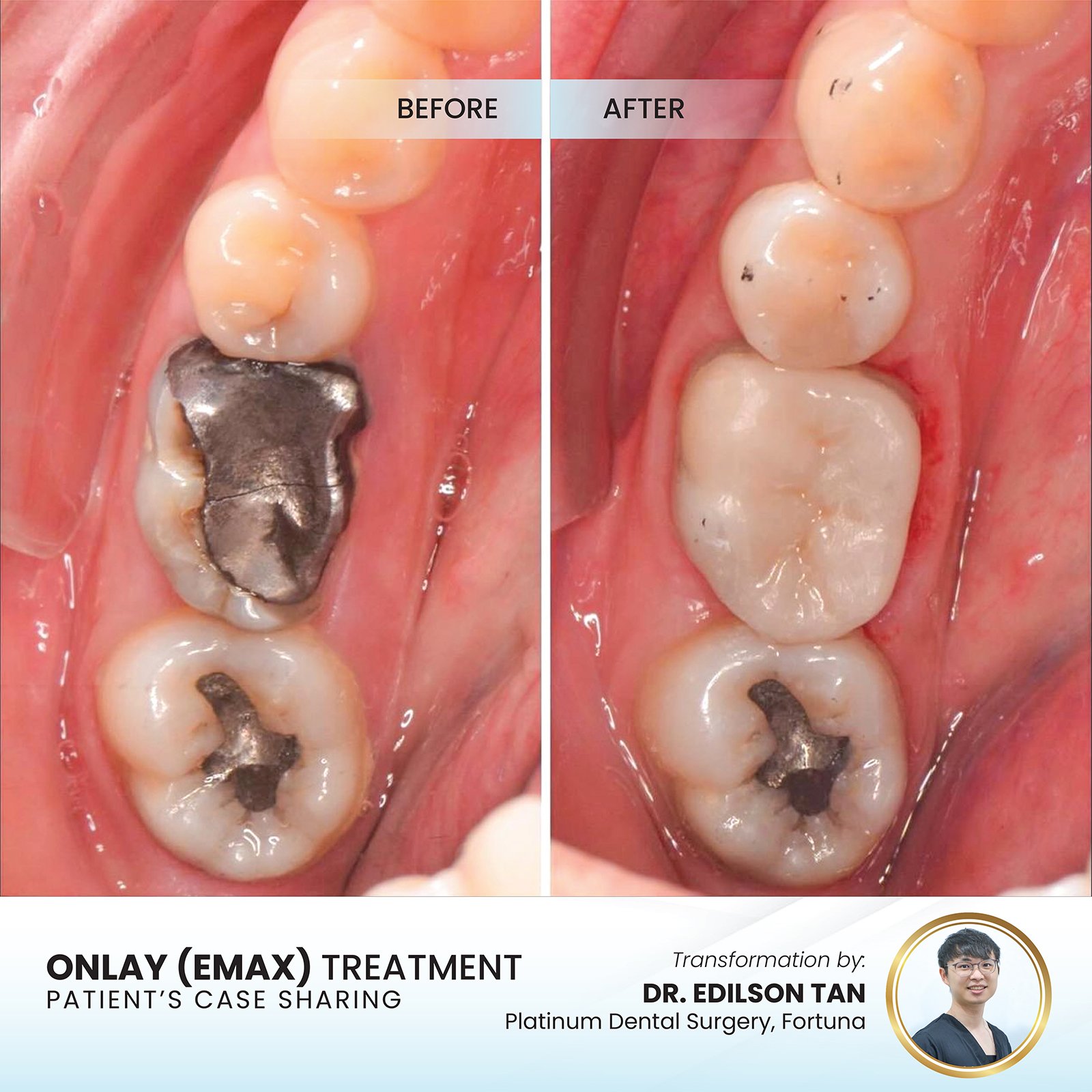 Onlay (Emax) — Dr. Edilson Tan