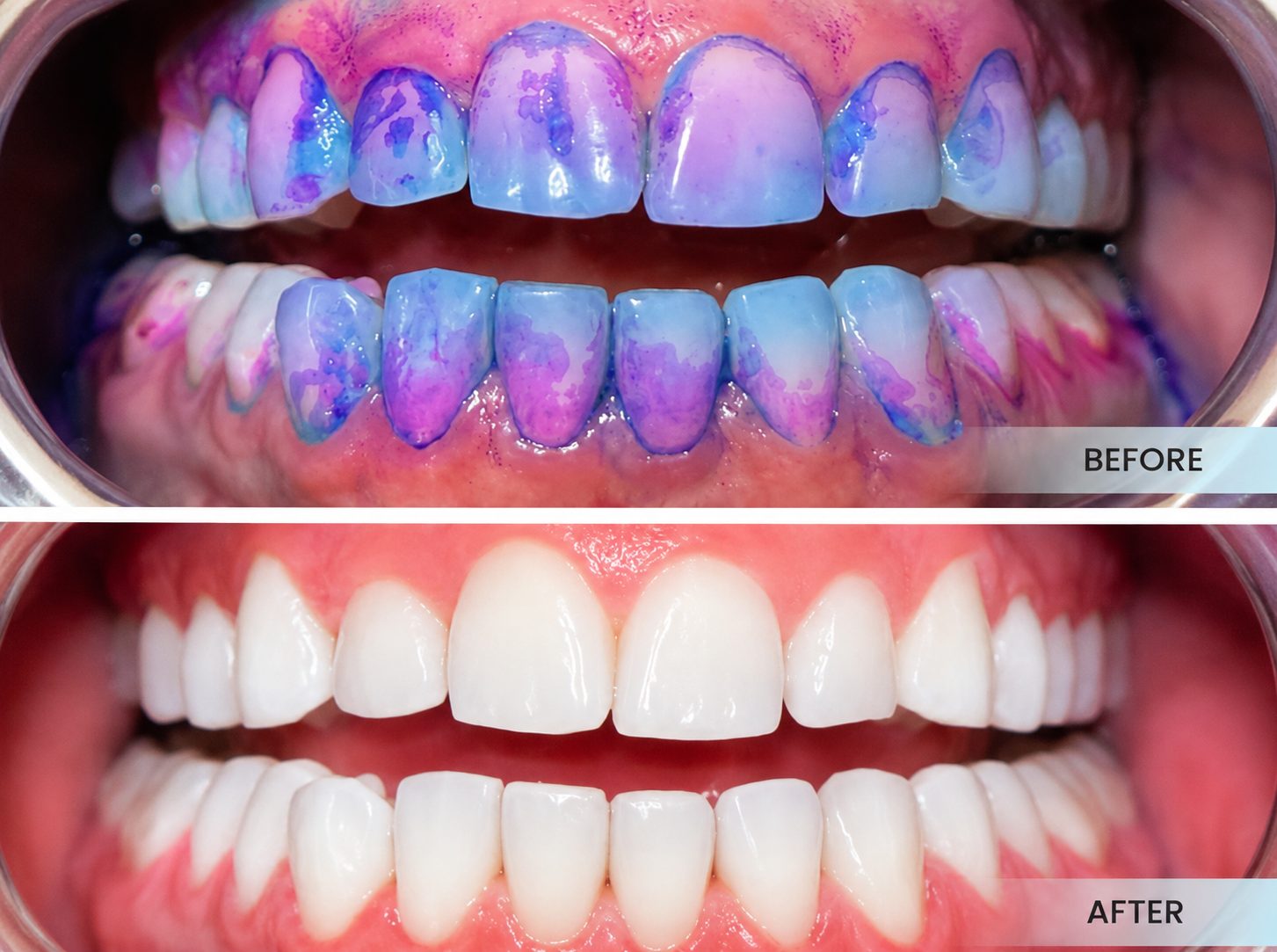 Guided Biofilm Therapy, Before & After