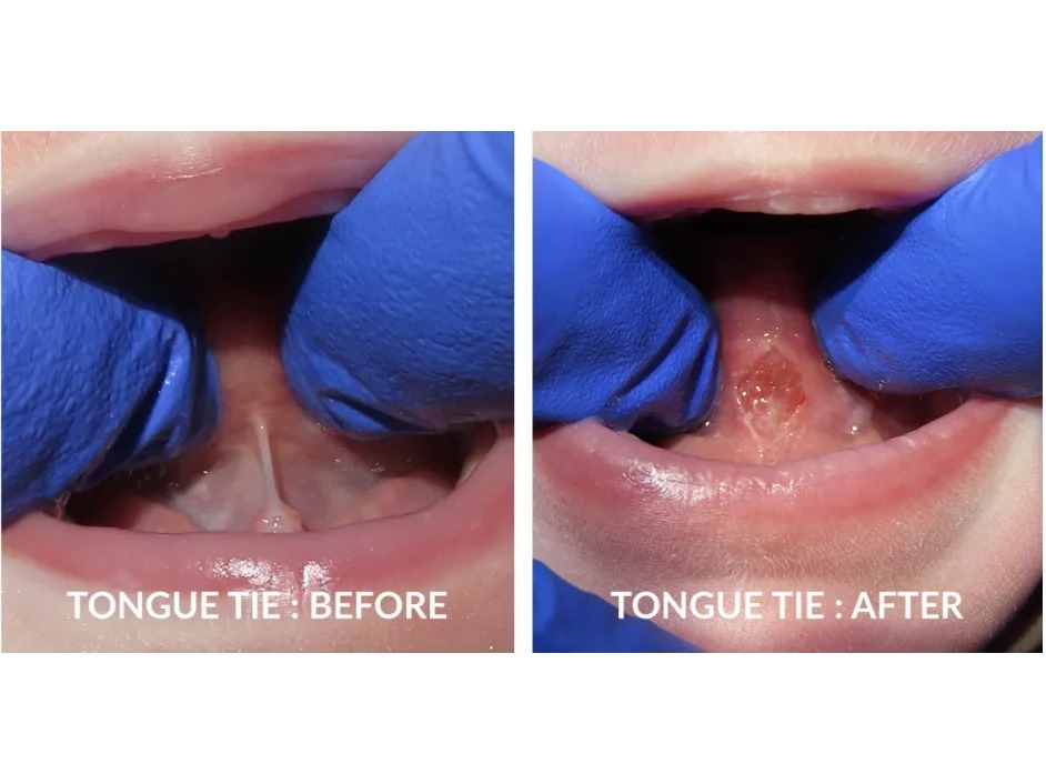 Frenectomy (Tongue-Tie & Lip-Tie Release)