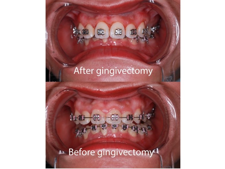 Gum Contouring & Crown Lengthening